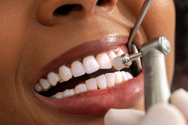 Teeth cleaning